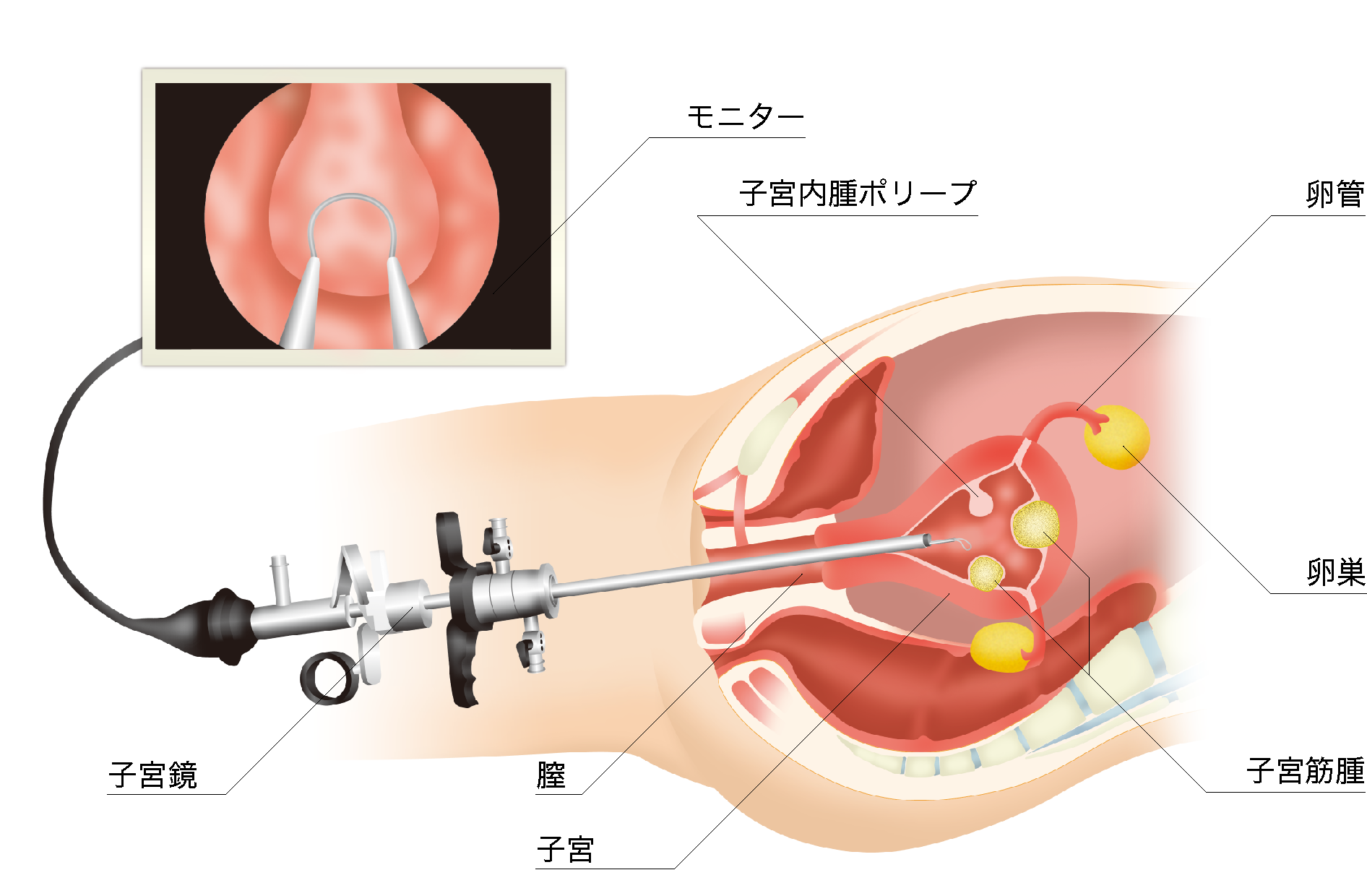 子宮鏡手術